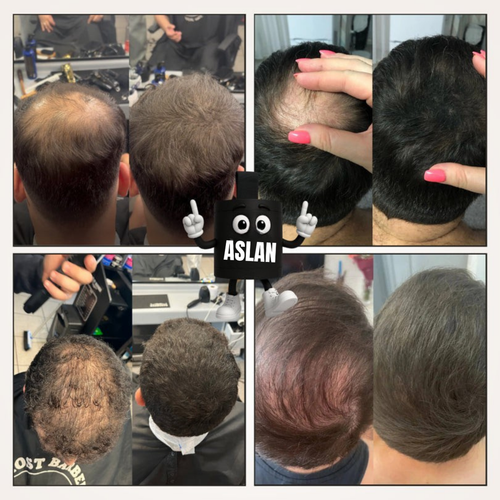 Instant Confidence for Thinning Hair